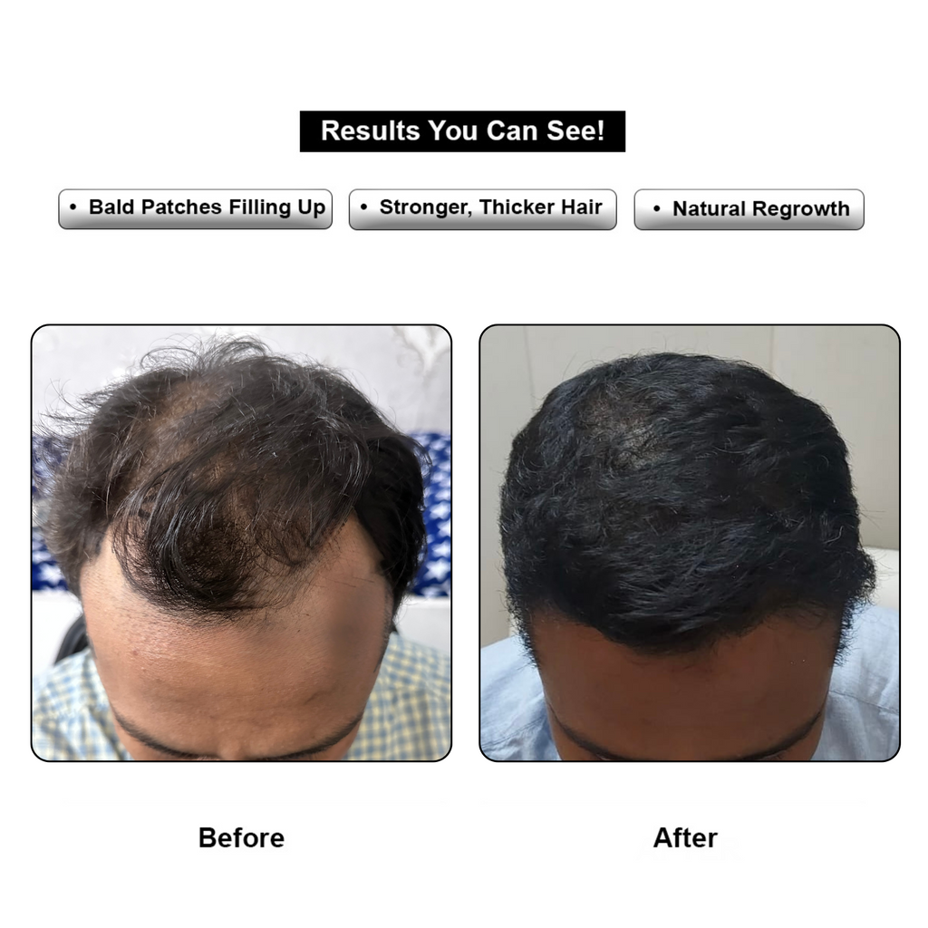 Hair ReGrowth Serum