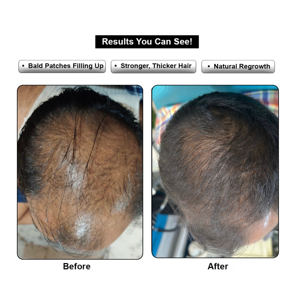 Hair ReGrowth Serum