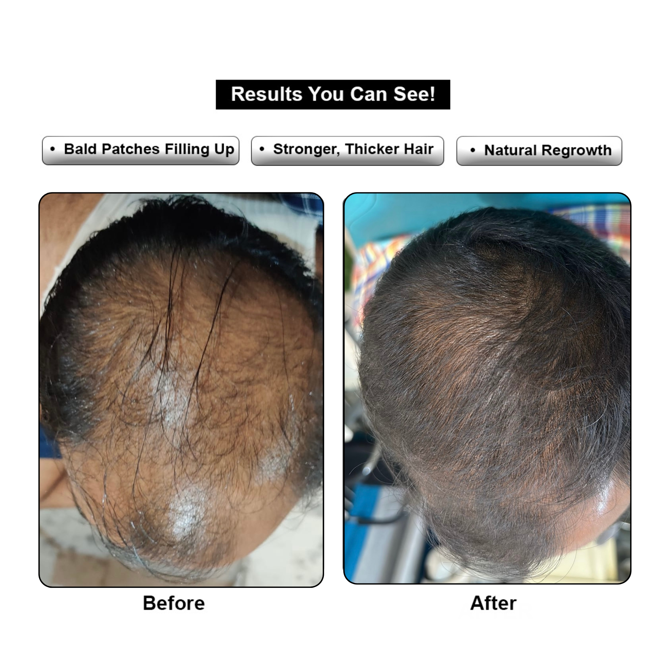Hair ReGrowth Serum
