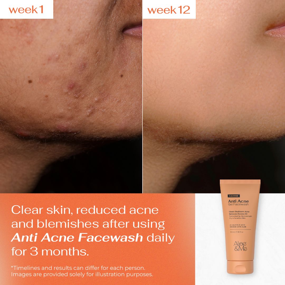 Anti-Acne Gel Face Wash with Salicylic Acid & Niacinamide for Pimples